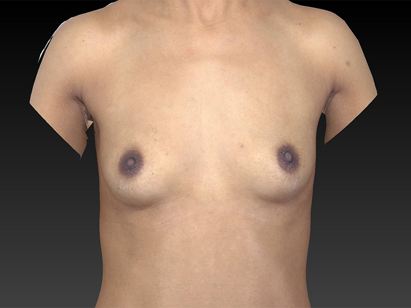 Breast Augmentation Before and After | Dr. Ulysses Scarpidis, MD - Scarpidis Aesthetics