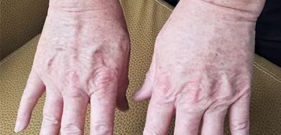 Hands Revived By HALO Laser. Here’s How It Can Help You!