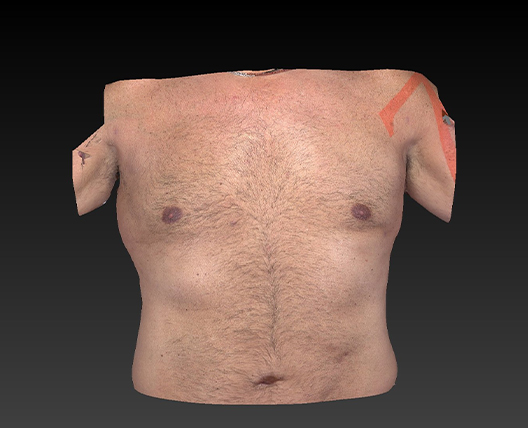 Smartlipo Gynecomastia Male Chest Before and After | Dr. Ulysses Scarpidis, MD - Scarpidis Aesthetics