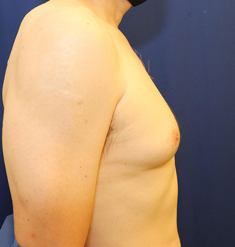 Smartlipo Gynecomastia Male Chest Before and After | Dr. Ulysses Scarpidis, MD - Scarpidis Aesthetics
