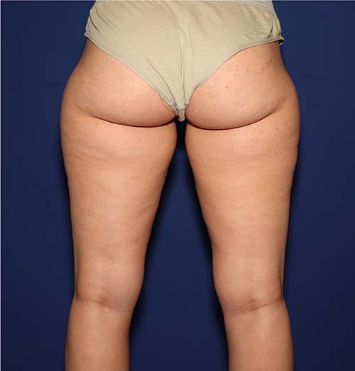 Smartlipo Office Liposuction Before and After | Dr. Ulysses Scarpidis, MD - Scarpidis Aesthetics