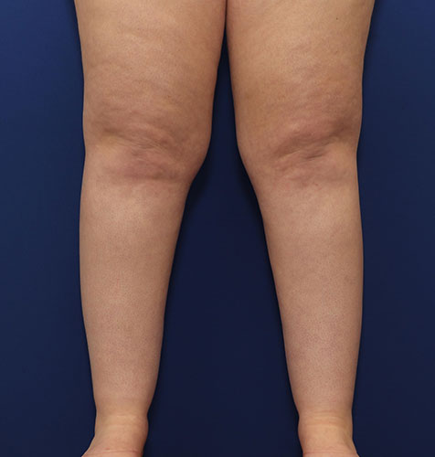 Smartlipo Office Liposuction Before and After | Dr. Ulysses Scarpidis, MD - Scarpidis Aesthetics