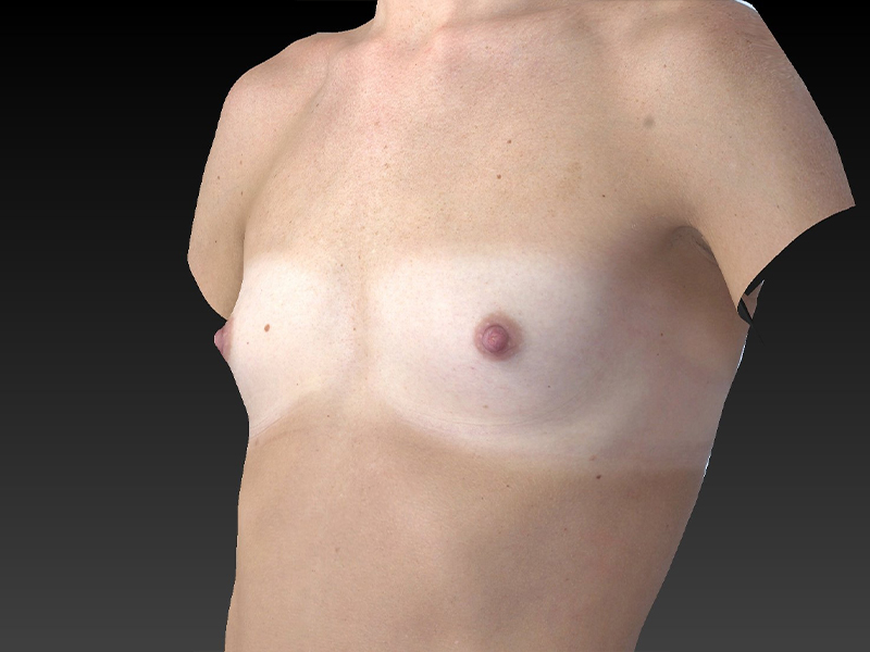 Breast Augmentation Before and After | Dr. Ulysses Scarpidis, MD - Scarpidis Aesthetics