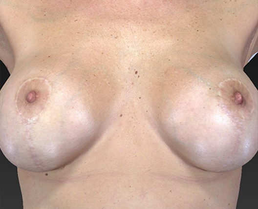 Breast Lift Before and After | Dr. Ulysses Scarpidis, MD - Scarpidis Aesthetics