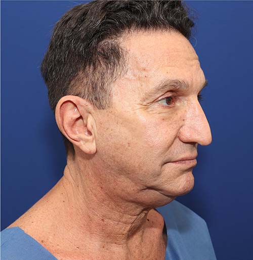 Precision Tx Before and After | Dr. Ulysses Scarpidis, MD - Scarpidis Aesthetics