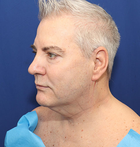 Precision Tx Before and After | Dr. Ulysses Scarpidis, MD - Scarpidis Aesthetics