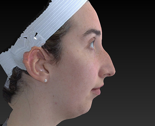 Chin Augmentation Before and After | Dr. Ulysses Scarpidis, MD - Scarpidis Aesthetics