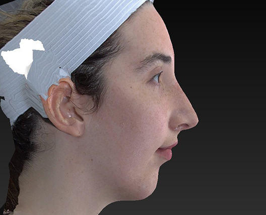 Chin Augmentation Before and After | Dr. Ulysses Scarpidis, MD - Scarpidis Aesthetics