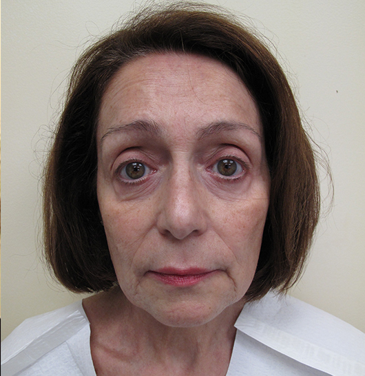 Facelift Before and After | Dr. Ulysses Scarpidis, MD - Scarpidis Aesthetics