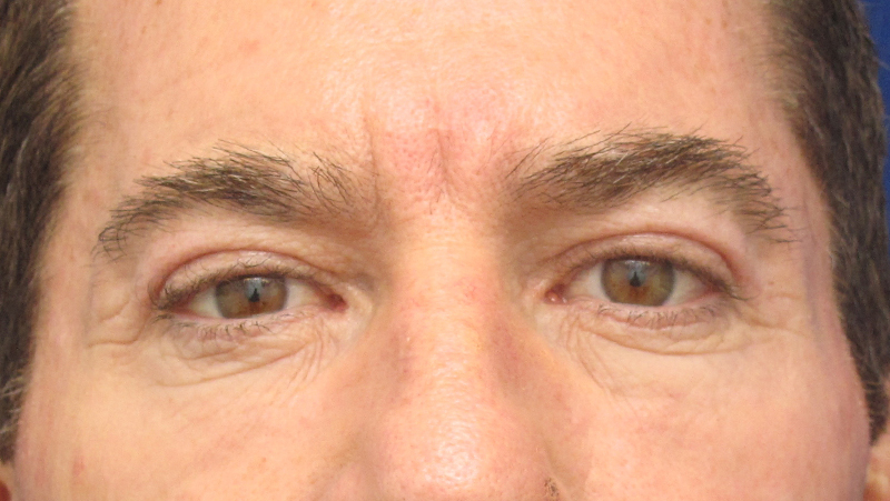 Upper Blepharoplasty Before and After | Dr. Ulysses Scarpidis, MD - Scarpidis Aesthetics