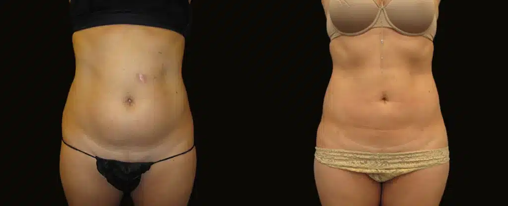 smartlipo office liposuction before and after photos by scarpidis aesthetics in new york ny