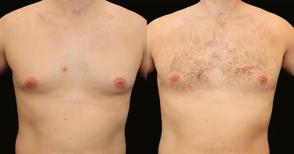 smartlipo gynecomastia male chest before and after photos by scarpidis aesthetics in new york ny