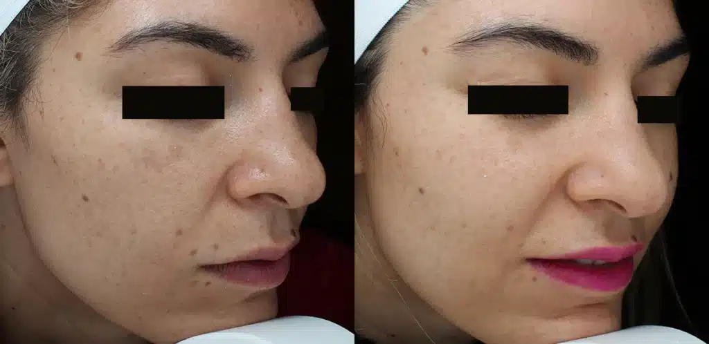 halo facial rejuvenation laser before and after photos by scarpidis aesthetics in new york ny