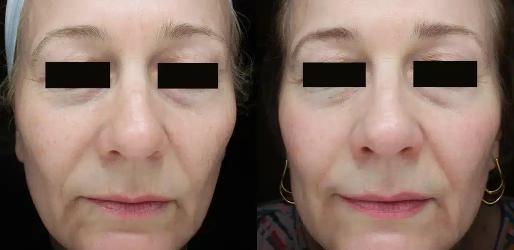 halo facial rejuvenation laser before and after photos by scarpidis aesthetics in new york ny