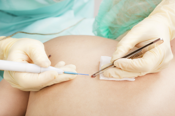 Mole Removal
