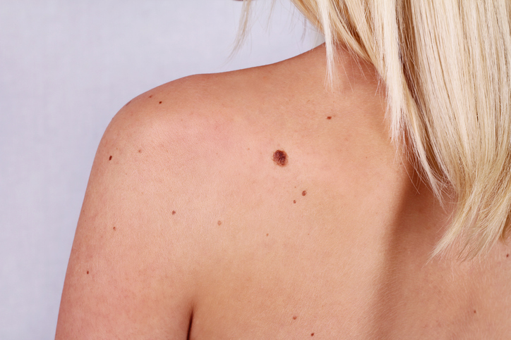 woman with moles