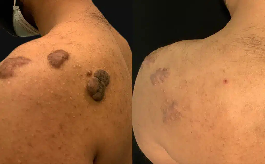 keloid excision before and after photos by scarpidis aesthetics in new york ny