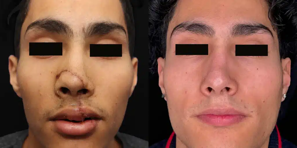 halo facial rejuvenation laser before and after photos by scarpidis aesthetics in new york ny